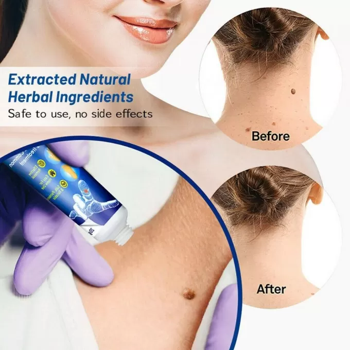 كريم إزالة الثآليل 2